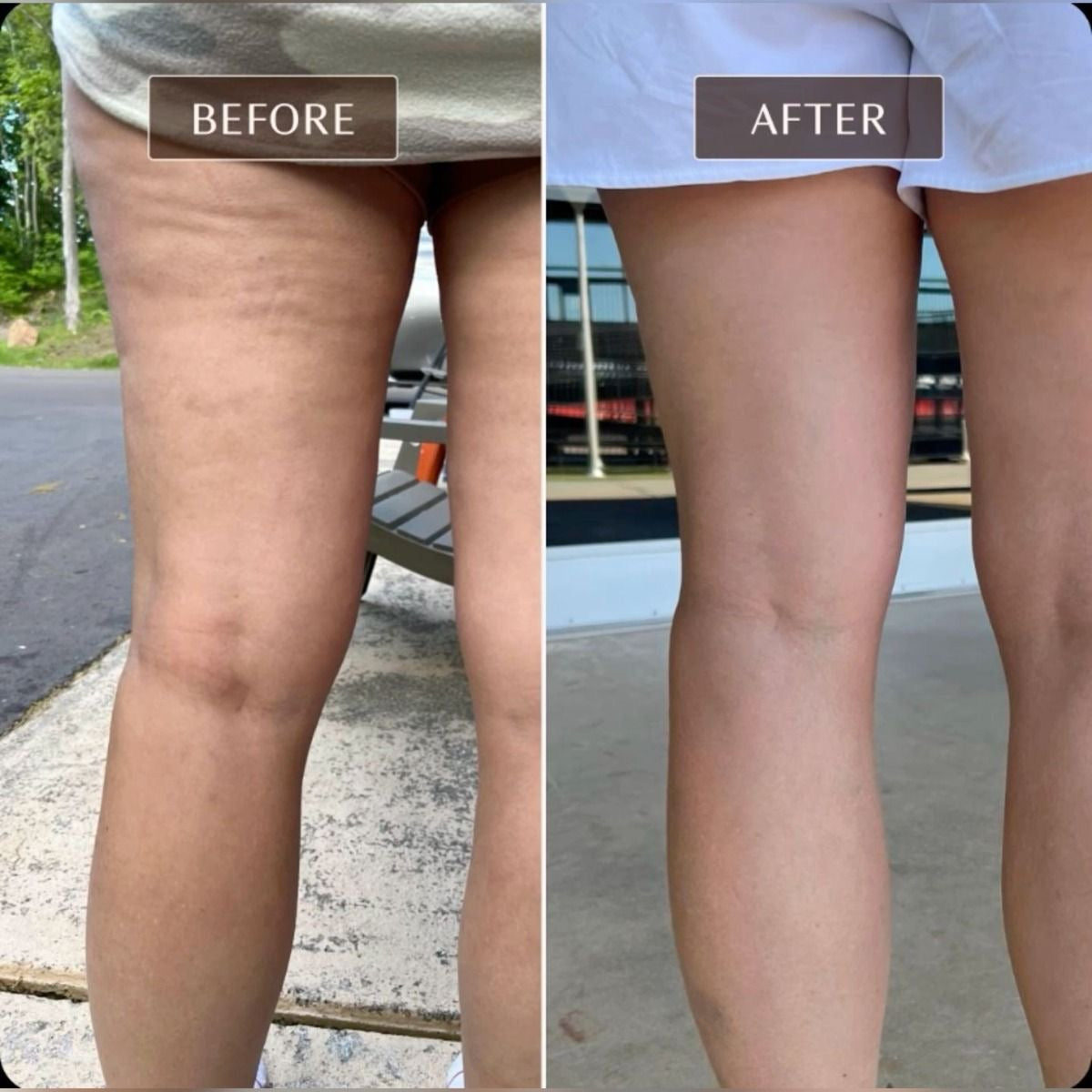 Solveskin - Circular Leg Clamp